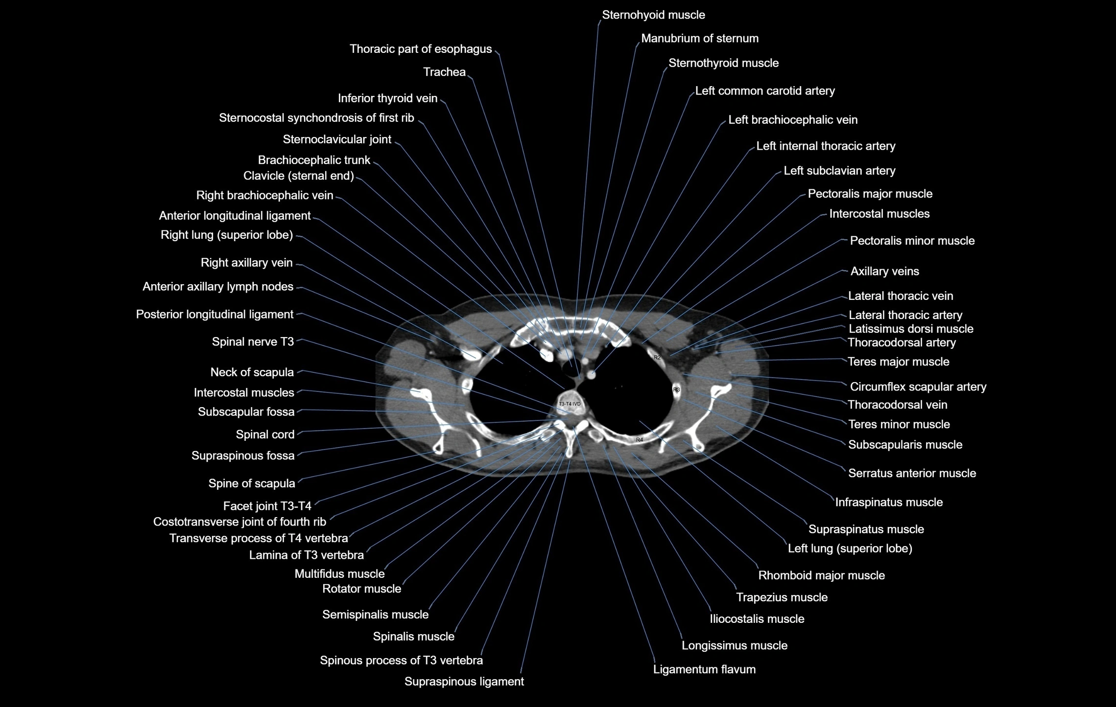 CT chest (thorax) soft tissue window labelled axial cross sectional anatomy radiology image-00022.webp